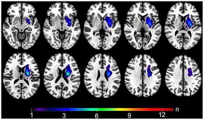 Relationship Between Cortical Excitability Changes and Cortical Thickness in Subcortical Chronic Stroke